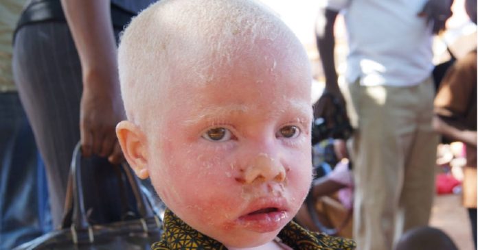 Santé : albinisme, comment réduire l’impact visuel ?