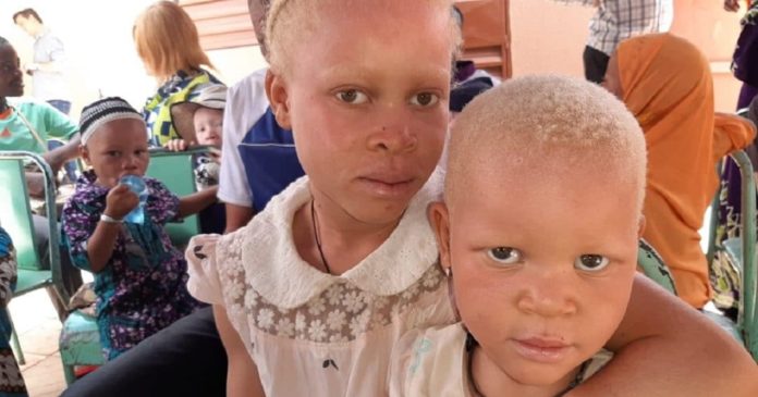 Albinisme au Kenya: des espérances malgré la discrimination